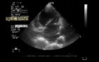 Myxomatous Mitral Valve with Mitral Valve Prolapse