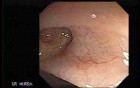 Colon Diverticula - Foot Steps Impression