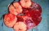 Non-Hodgkin's lymphoma of the spleen