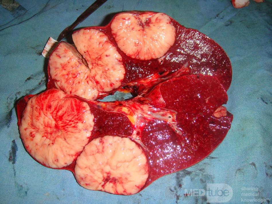 Non-Hodgkin's lymphoma of the spleen