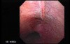 Esophageal Mucosal Bridge- Image of the Longitudinal Musocal Bridge