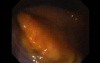 Gastrointestinal Stromal Tumor - GIST (40 of 65)