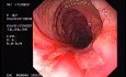 Crohn's Disease - Endoscopy (24 of 28)