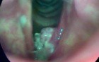 Laryngeal Cancer involving the left vocal fold and subglottis