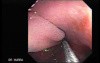 Colonoscopic Polypectomy (8 of 23)