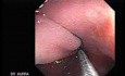 Colonoscopic Polypectomy (8 of 23)