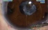 Pupilloplasty & Membranectomy - Fugo Blade