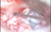 Cholesteatoma - Canal Up Mastoidectomy Incision - Part 2 - Sac Dissec