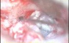 Cholesteatoma - Canal Up Mastoidectomy Incision - Part 2 - Sac Dissec