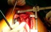 Cabg - Total Arterial Awake Off Pump Coronary Artery Bypass Grafting 