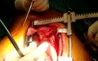Cabg - Total Arterial Awake Off Pump Coronary Artery Bypass Grafting 