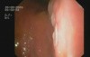 Gastric Cancer
