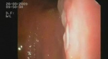 Gastric Cancer