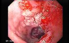 Esophageal Squamous Cell Carcinoma of the the Upper Third of the Esophagus - Large and Ulcerated Carcinoma