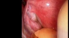 Diagnostic Laparoscopy