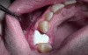 Bone Grafting #5 Site - Mineross/Cytoplast d-PTFE - 2 Week p-o