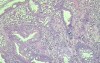 Case on Multiple Adenomas (large polyps) of the Rectum (33 of 37)