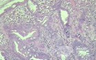 Case on Multiple Adenomas (large polyps) of the Rectum (33 of 37)