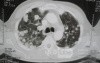 Chest Metastasis Due To Renal Cell Carcinoma