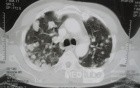 Chest Metastasis Due To Renal Cell Carcinoma