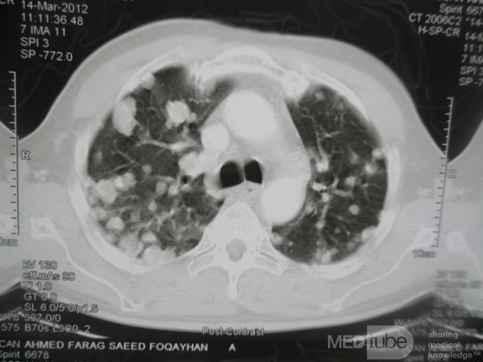 Chest Metastasis Due To Renal Cell Carcinoma