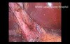 Laparoscopic cholecystectomy