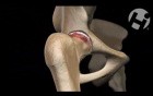 Total Hip Replacement