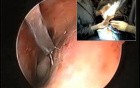 Endoscopic Laser Assisted Dacryocystorhinostomy (ELA-DCR) For Blocked Tear Ducts