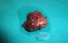 Giant Multilobulated Gastric Polyp (18 of 20)