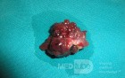 Giant Multilobulated Gastric Polyp (18 of 20)