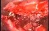 Uterine Myoma Laparoscopic Treatment