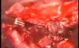 Uterine Myoma Laparoscopic Treatment