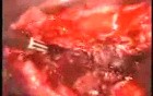 Uterine Myoma Laparoscopic Treatment