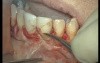 Complicated Extraction Of Tooth 11 (1/2)
