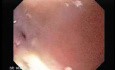 Stenosis of the esophagus caused by radiotherapy with cobalt to a carcinoma (1 of 2 )