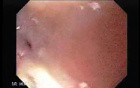 Stenosis of the esophagus caused by radiotherapy with cobalt to a carcinoma (1 of 2 )