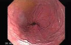 Hourglass stomach endoscopy
