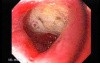 Duodenal Ulcer (2 of 4)