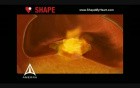 SHAPE - Heart Attack PSA - 3D Medical Animation