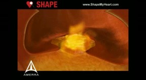 SHAPE - Heart Attack PSA - 3D Medical Animation