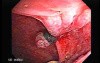 Status Post Rubber Band Ligation for Internal Hemorrhoids (7 of 7)