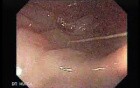Gastrointestinal Stromal Tumour of the Rectum (1 of 3)
