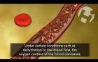 Sickle Cell Anemia Process