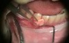 Periodontal Grafting - Microsurgery