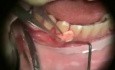 Periodontal Grafting - Microsurgery