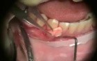Periodontal Grafting - Microsurgery