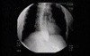 Esophageal Achalasia - Appearance of the Esophagus
