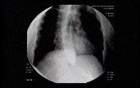 Esophageal Achalasia - Appearance of the Esophagus