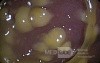 Endoscopic appearance of the Pseudomembranous colitis
