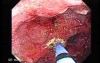 Multiple Adenomatous Polyps Of The Rectum (20 of 37)